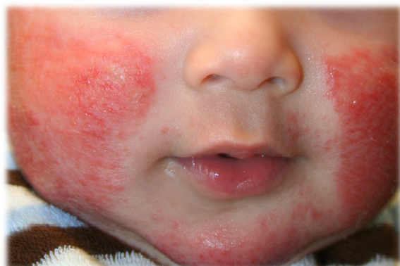Atopic Dermatitis