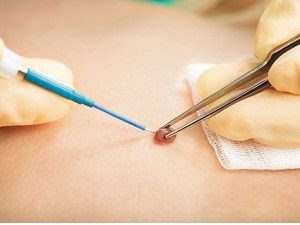 electrocoagulacion de verrugas