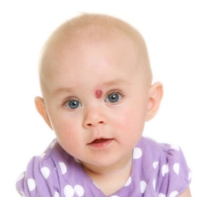 hemangioma infantil