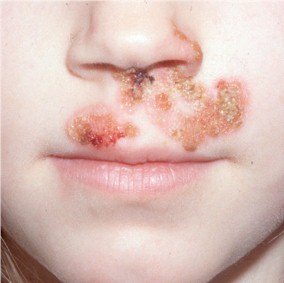 impetigo