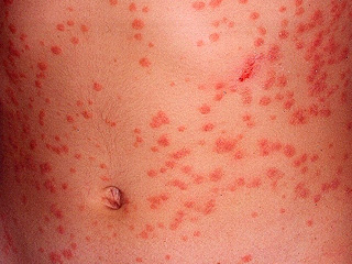 psoriasis guttata